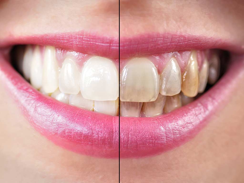 teeth-whitening-merrion-square